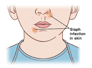 Staph Infection (non-MRSA) - Sterling Care - In-Home Care Westchester