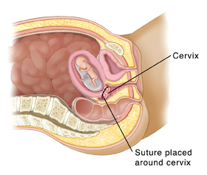 c pregnancy t positive test Sterling Childbirth: Transvaginal  and Pregnancy Cerclage