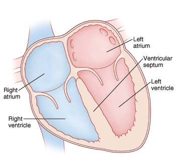 When Your Child Has a Ventricular Septal Defect (VSD) - Sterling Care ...