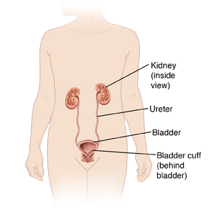 Laparoscopic Nephroureterectomy - Sterling Care - In-Home 