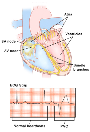 Premature Ventricular Contractions - Sterling Care - In 