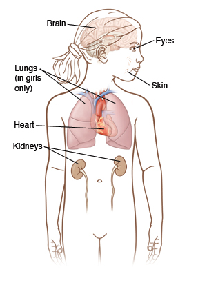 When Your Child Has Tuberous Sclerosis Complex (TSC 