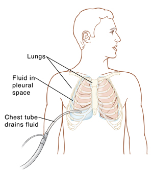 Chest Tubes - Sterling Care - In-Home Care Westchester NY - In-Home ...