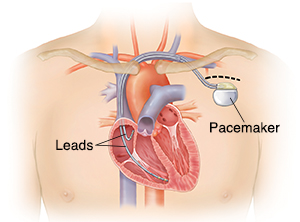 Pacemakers - Sterling Care - In-Home Care, Greenwich, CT