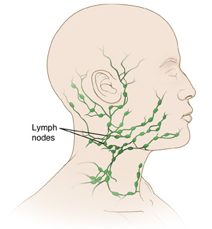 Excisional Biopsy: Neck Lymph Node - Sterling Care - In-Home Care ...